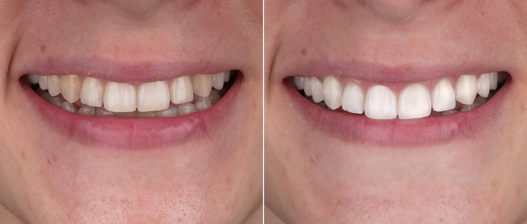 antes y después de blanqueamiento dental