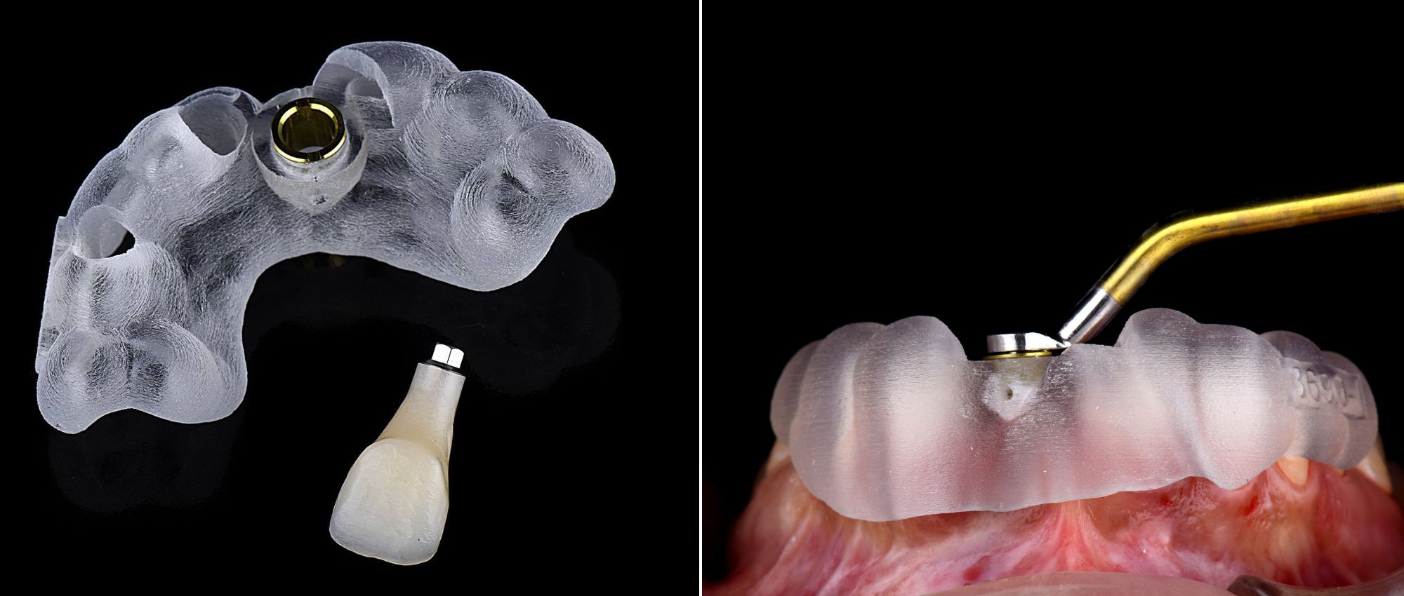 cirugía de implantes dentales con guiada